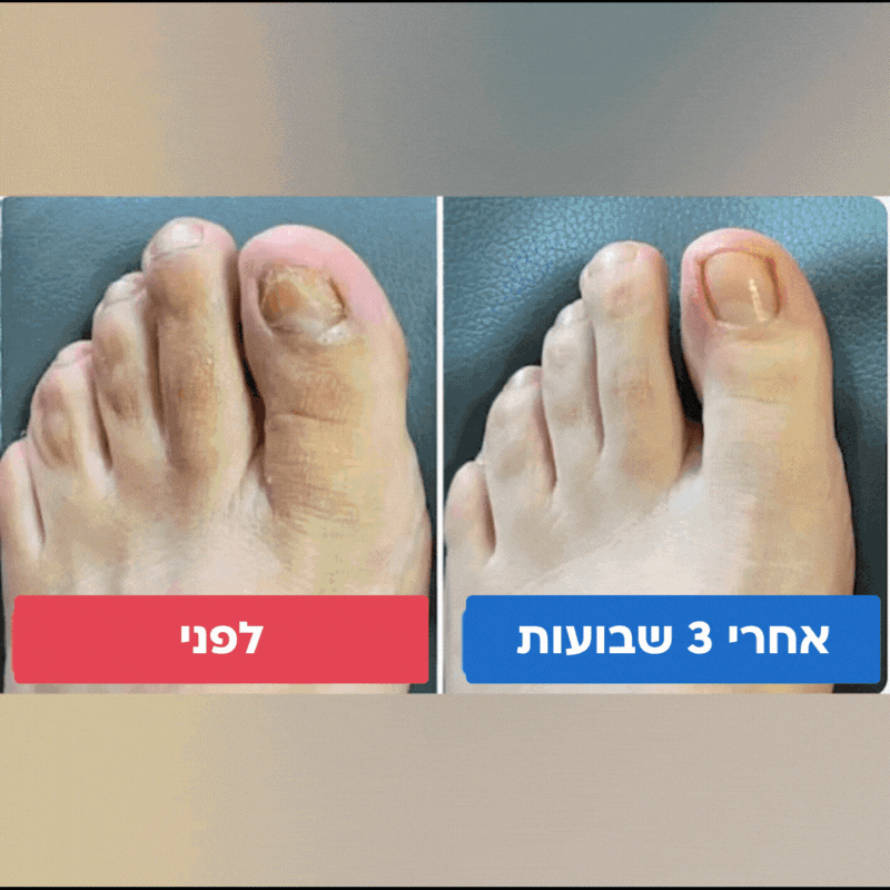 מדבקות לשיקום הציפורניים